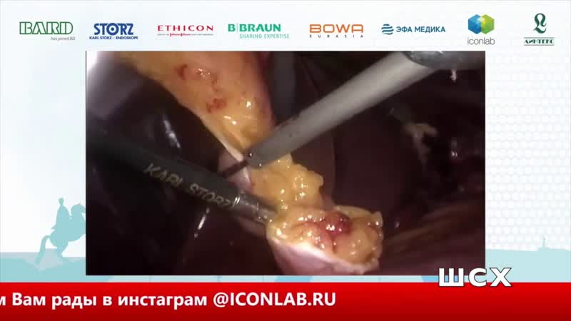 В. Анищенко Повторная фундопликация ( Redo