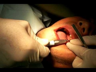 Sapian Root Remover- Fast and Easy Extractions