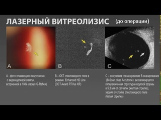 Лазерный витреолизис